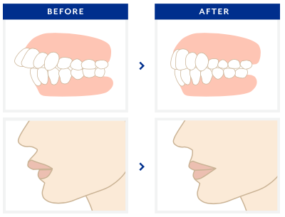 いちばんキレイな横顔とは 南千住の矯正歯科 南千住小児歯科矯正歯科 土日診療 南千住の矯正歯科専門医院 南千住小児歯科矯正歯科